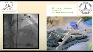 Basics of Coronary Angiography - Prof. Mohamed El-Ramly