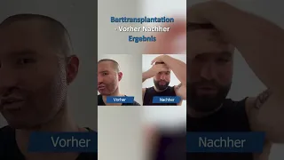 Barttransplantation Vorher Nachher | Elithair #shorts