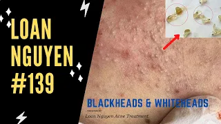 Remove many blackheads, the longest case of acne of the week (139) | Loan Nguyen