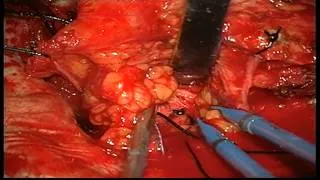 retrobulbar intraconal orbital cavernous hemangioma operated by Prof Dr Selçuk YILMAZLAR