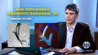 Tips no Tratamento da Hipertensão Portal Parte II 3/7