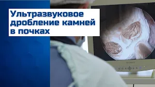 Дробление камней в почках ультразвуком