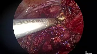 Laparoscopic hysterectomy - Distorted anatomy