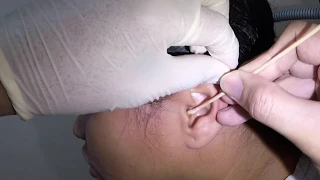 Woman's Earwax Finally Removed After Weeks of Having A Clogged Ear