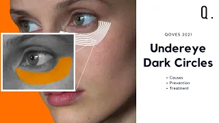How To CORRECTLY Fix Dark Undereye Circles | Causes, Prevention and Etiology
