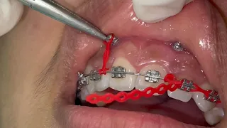 Gummy smile with orthodontic mini screws, incisors intrusion with TADs with power chain placement