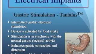 Electrical Implants (gastric and vagal pacing)