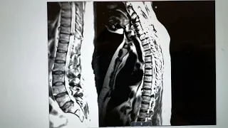 Leapfrog method to confirm thoracic level Intraoperatively