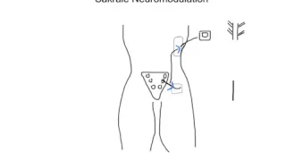 Sakrale Neuromodulation