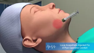 Medical Animation | Facelift Procedure