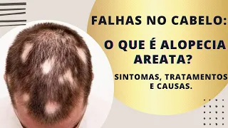 O que é alopecia areata? sintomas causas e tratamento