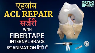 Advanced #ACL Repair Surgery with FiberTape Internal Brace का #Animation in Hindi @OrthoIllustrated