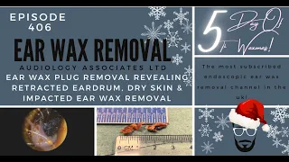 EAR WAX PLUG REMOVAL REVEALING RETRACTED EARDRUM, DRY SKIN & IMPACTED EAR WAX REMOVAL - EP406