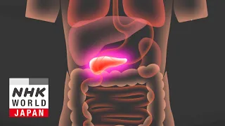 Destroying Pancreatic Cancer with Ultrasound - Medical Frontiers