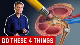 Preventing High Oxalate Kidney Stones