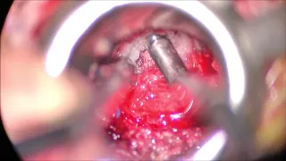 Lumbar MIS Tubular Decompression including contralateral and ipsilateral passes