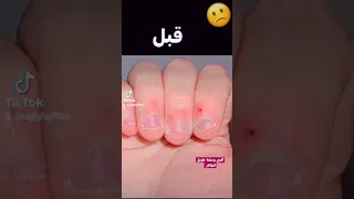 تطويل الأظافر في يوم واحد بمكونات بسيطة ❤️👍