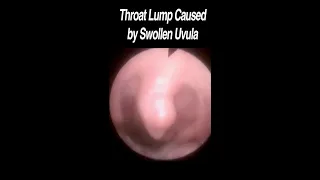 Swollen Uvula Causing Lump Sensation in Throat #shorts #throatlump #globus  @fauquierent