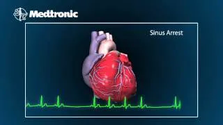 What Is Bradycardia ?