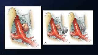 Pterional Craniotomy for Clipping of a Ruptured Fetal Posterior Cerebral Artery Aneurysm