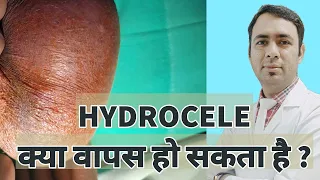 HYDROCELE - CAN IT COME BACK ? RECURRENCE ? क्या दोबारा वापस हाइड्रोसिल हो सकता है ?