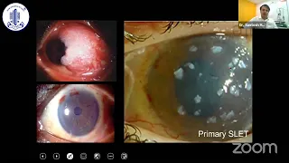 Surgical Management of Ocular Surface Squamous Neoplasia - Dr. Santosh G Honavar