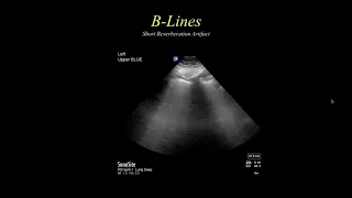 The BLUE Protocol  Bedside Lung Ultrasound in Emergency