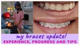 1 MONTH BRACES UPDATE | FIRST TIGHTENING | Braces Pain and Braces journey  #braceswithdolly