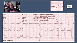 Acute Coronary Syndromes, STEMI Recognition, STEMI Mimics