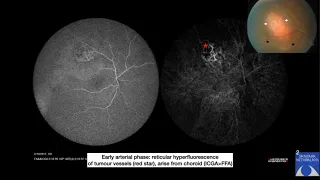 Exudative Retinal Detachment A Clinical Approach by Dr. Richa, 28 Nov 2020