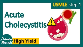 Acute cholecystitis | What is the most common treatment for cholecystitis? |Pathology of Acute chole