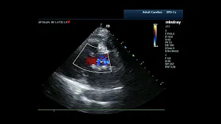 How to...Assess AR by Color Doppler