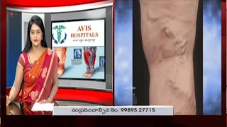 Varicose Veins - Symptoms, Treatment & Diagnosis Explained by Dr Rajah V Koppala  | Avis Hospitals