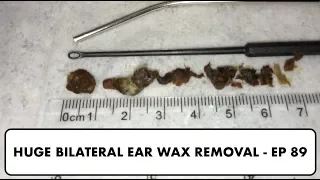 HUGE BILATERAL EAR WAX REMOVAL - EP 89