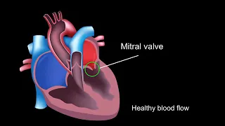 Physiology of rheumatic heart disease