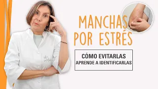 Manchas en la Piel por Estrés - Aprende a Evitarlas