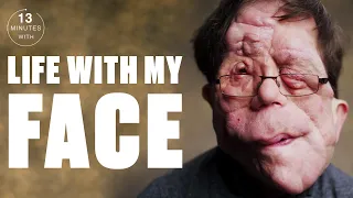 I Had Over 30 Surgeries To Remove Tumours Growing On My Face | Minutes With | @LADbible