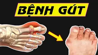 Hiểu rõ về Bệnh Gút chỉ trong 5 phút