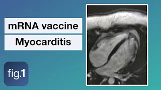 COVID-19 vaccine related myocarditis: explained