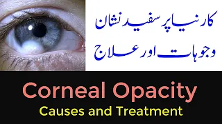 Corneal Opacity Causes and Treatment | Urdu Hindi