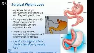 Fatty Liver Disease and Liver Transplantation:  For Adults and Children, What Patients Need to Know