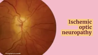 Ischaemic optic neuropathy (Neuro-Ophthalmology)