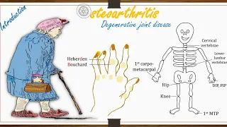 Osteoarthritis (Degenerative joint disease) Part-1 :- Introduction.