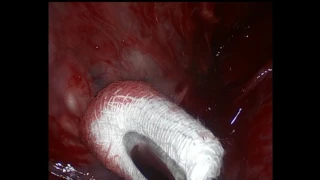 Гангрена легкого - ВТС лобэктомия ЛНД. VTS lung resection gangreen of lung