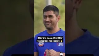 case study of ms dhoni hair transplant surgery #dhoni #dhoniforever #hairtransformation