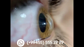 Keratoconus / Keratokonus / Кератоконус