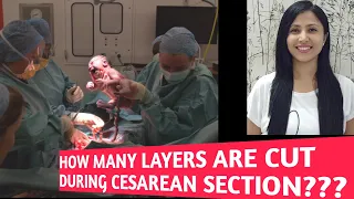 C SECTION ANATOMY| CESAREAN SECTION | LAYERS CUT DURING CESAREAN SECTION| HINDI| #obg ,#medical