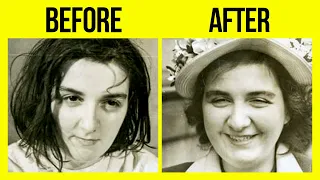 Before And After Photos Of People Who Underwent Lobotomies Are Disturbing