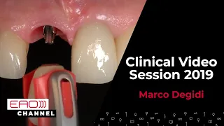 NO screw, no glue the prosthodontist's dream comes true w/ Marco Degidi/ Clinical Video Session 2019