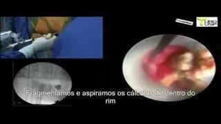 Tratamento para grandes cálculos ou pedras nos rins - Nefrolitotripsia Percutanea em DDH